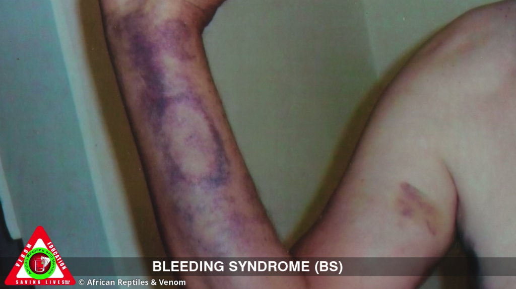 Bleeding Syndrome