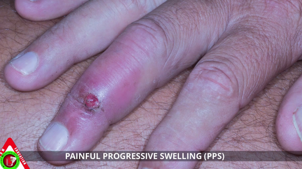 Painful Progressive Swelling Syndrome